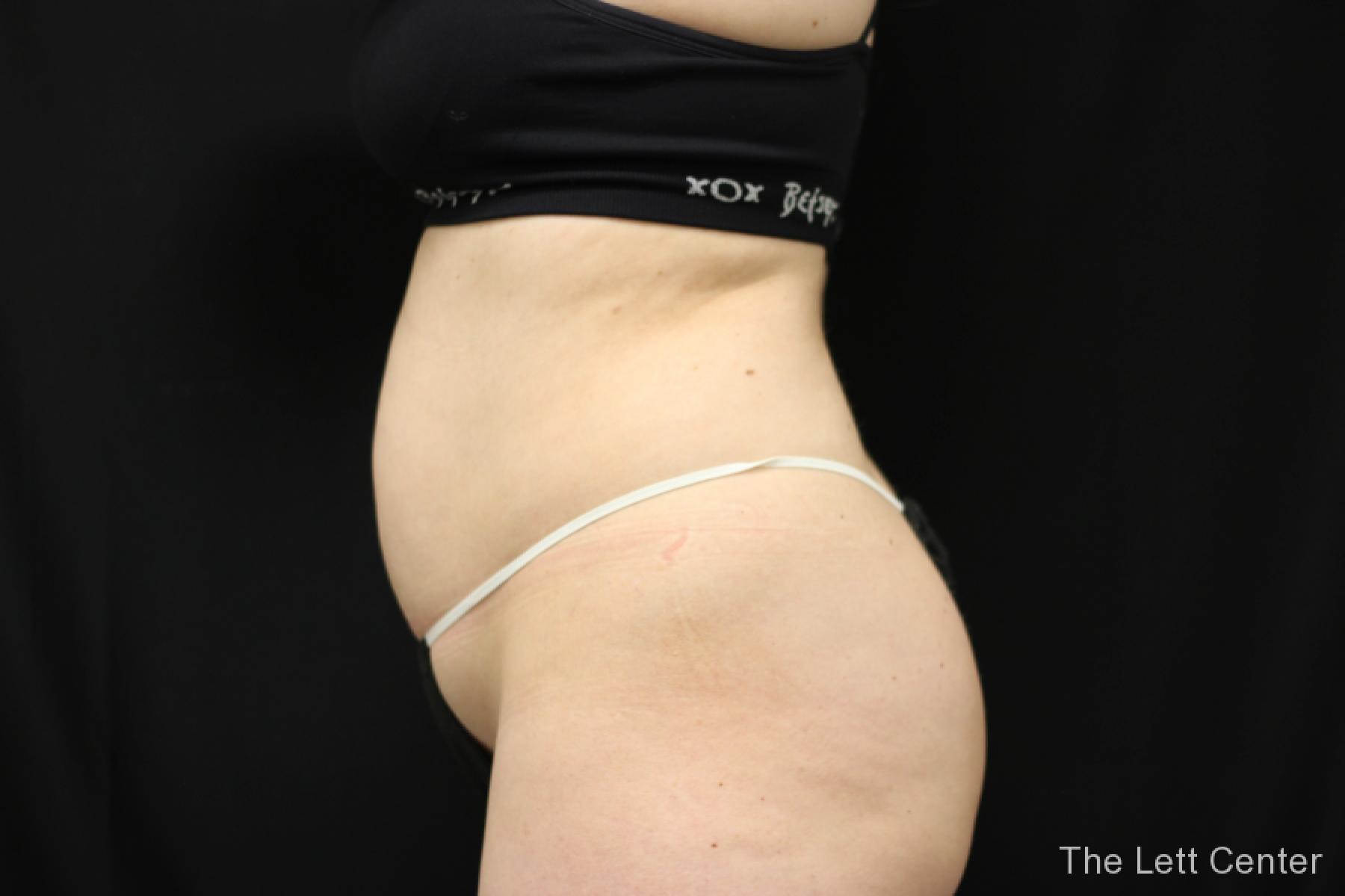 bodytite body contouring - Before and After 2