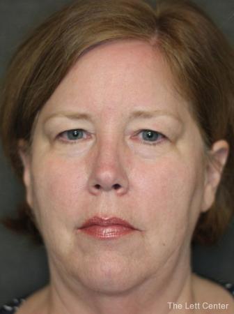 Blepharoplasty: Patient 2 - Before and After Image 4
