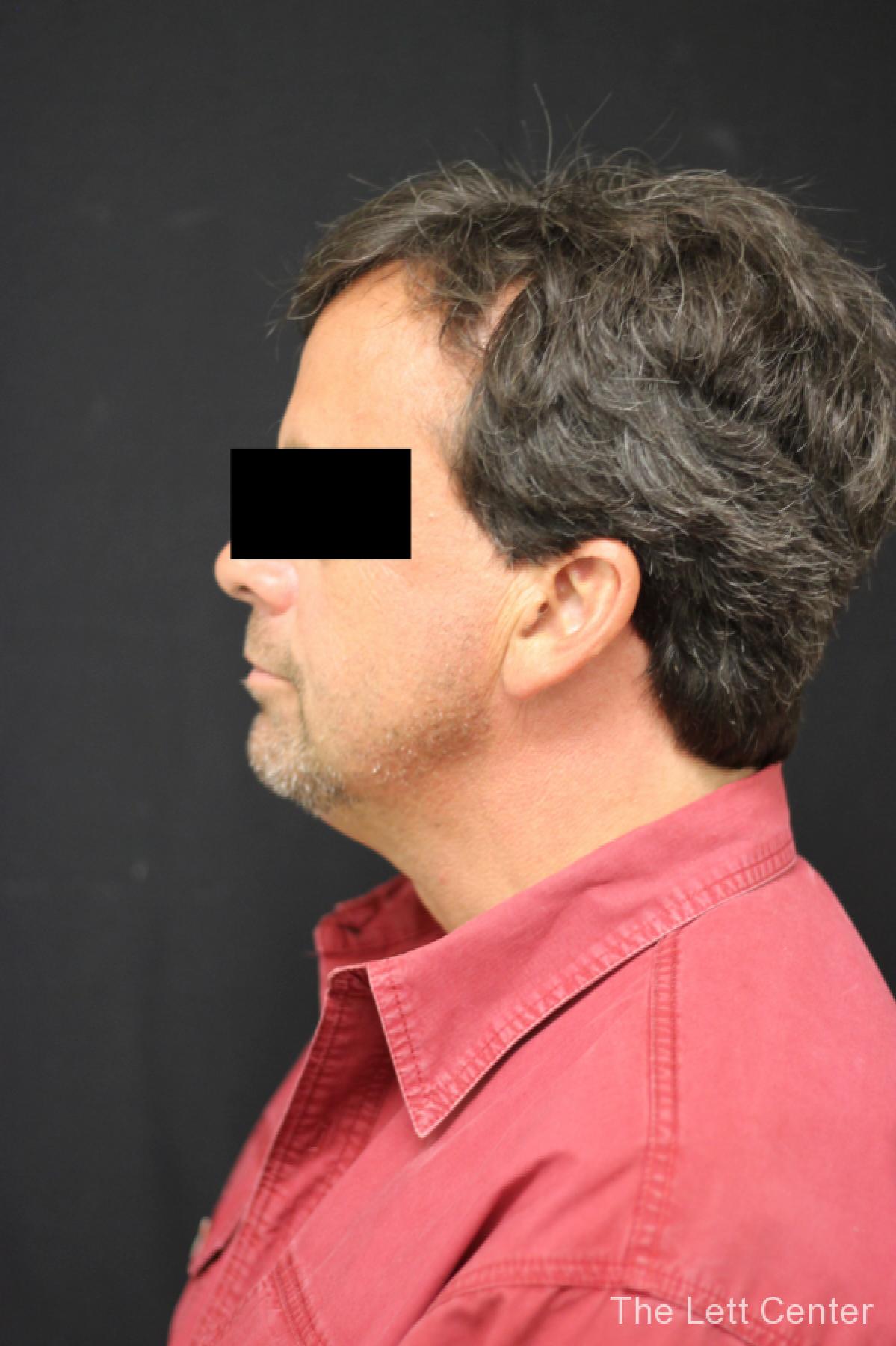 CoolSculpting for Men in Lebanon, TN | Schedule a Consultation Today - After 2