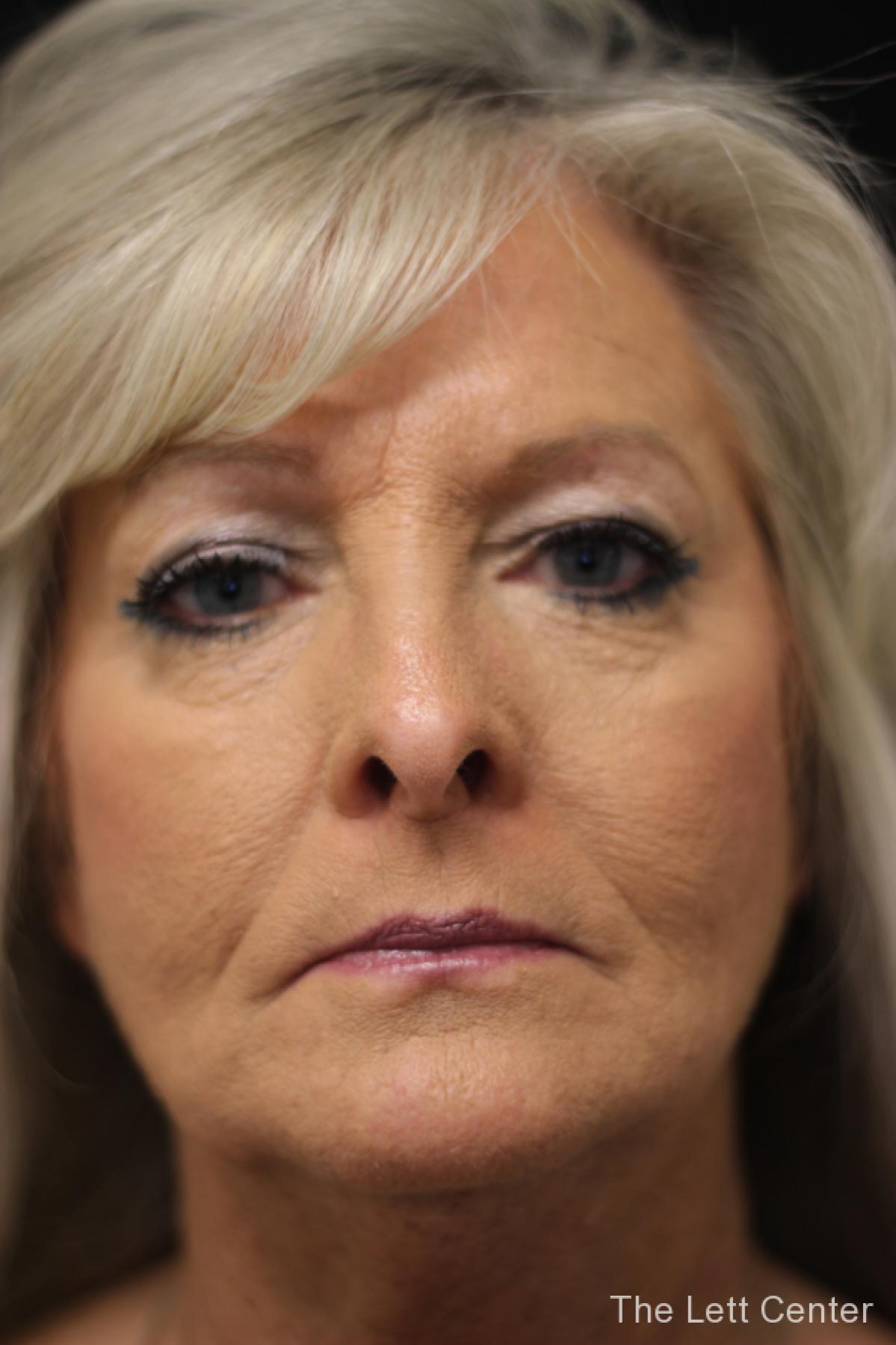 blepharoplasty eyelid surgery - Before