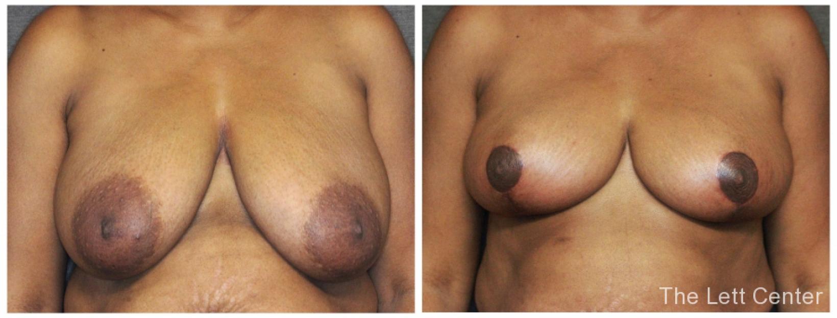 breast reduction plastic surgery lebanon tn - Before and After