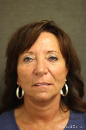 Facelift: Patient 2 - After Image 1