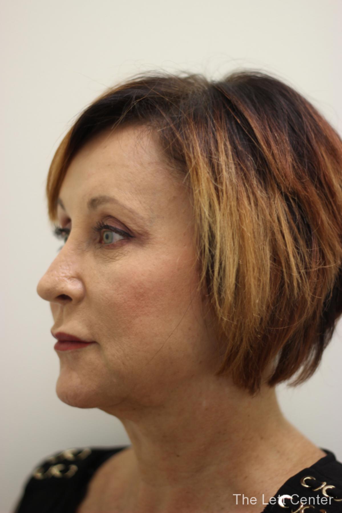 brow lift procedure - After 2