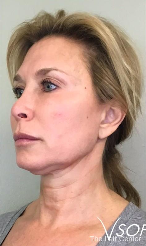 nonsurgical neck lift pdo threads mt juliet and lebanon tn - After