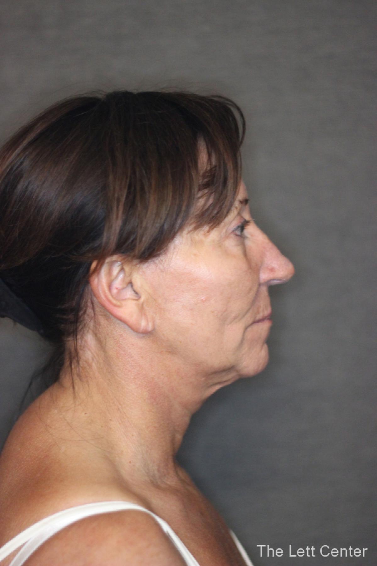 Results from Patient 2 from Facelift Surgery at The Lett Center - Before 3