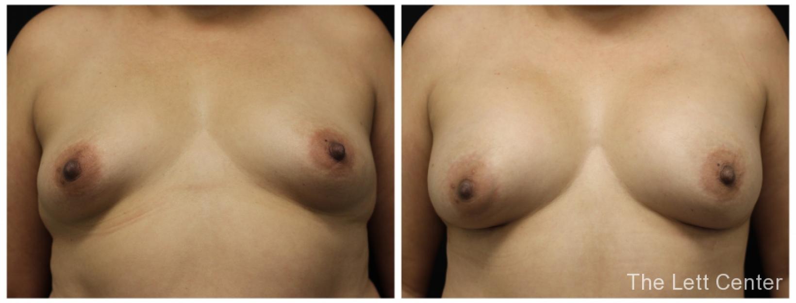 breast augmentation B&A - 11 weeks post breast aug with dr lett 11 plastic surgery lebanon - Before and After 1