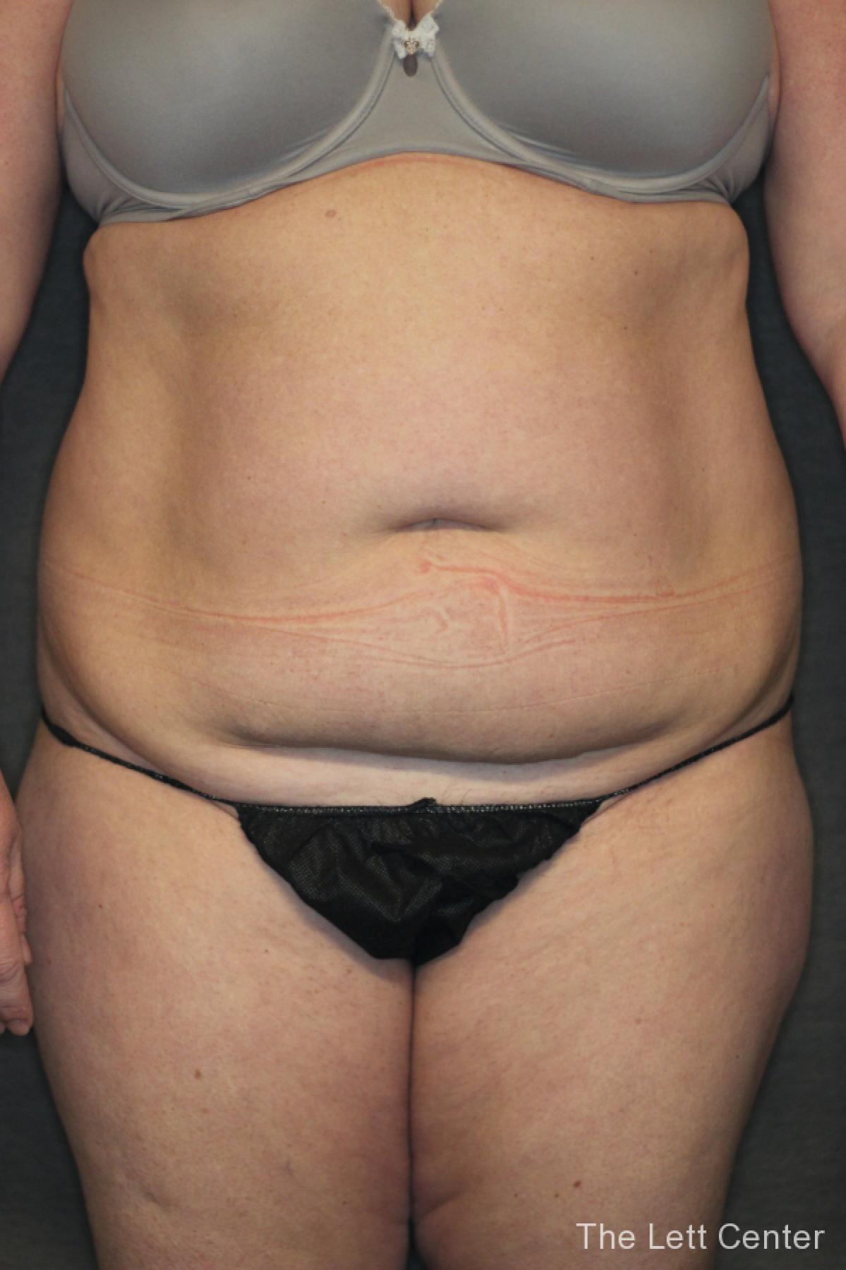 Abdominal Liposuction Results | Before After Gallery - Before and After 4