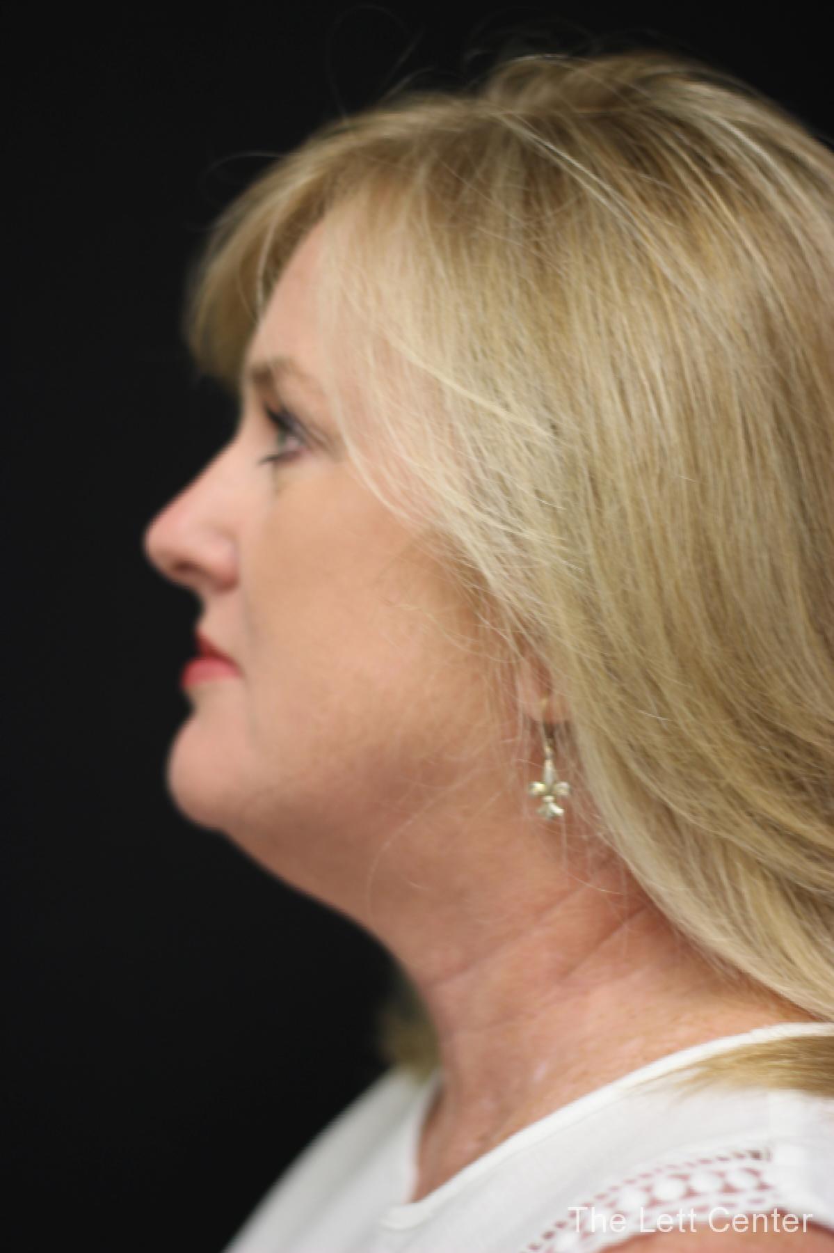 FaceTite treatments at The Lett Center in Lebanon, TN - Before 2