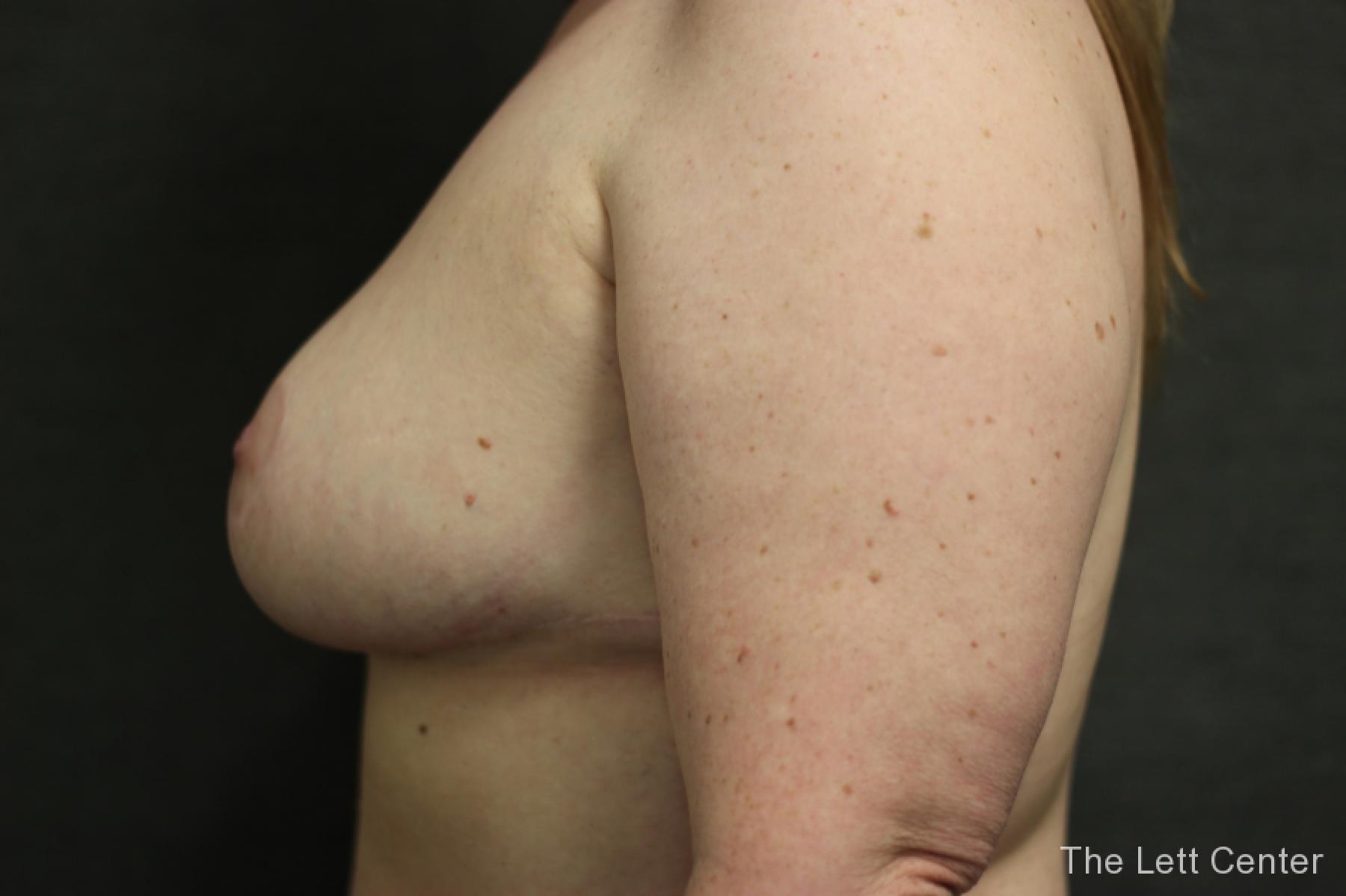 Before and After images from Breast Reduction Surgery -  After 2