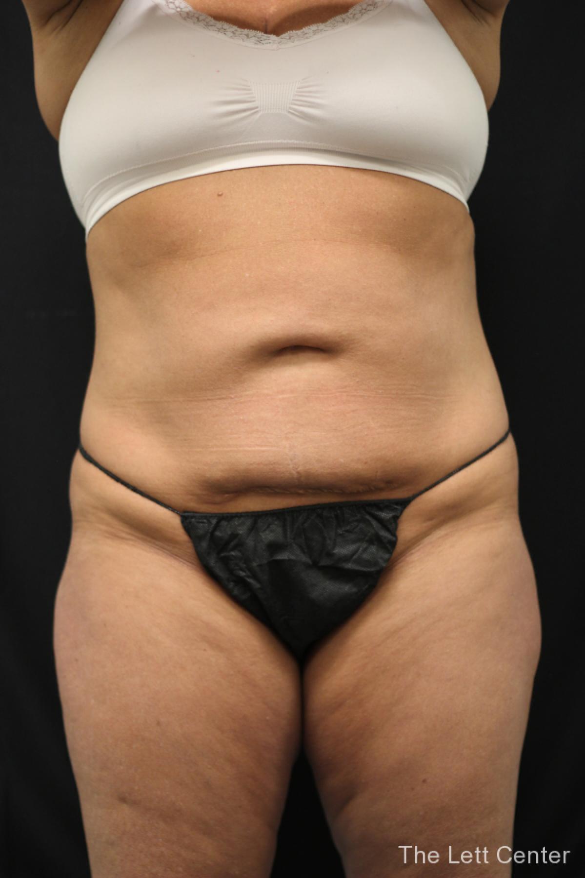 Abdominal Liposuction Results | Before After Gallery - After 4