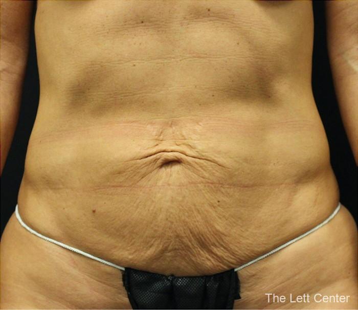 Abdominoplasty Skin Only - Before