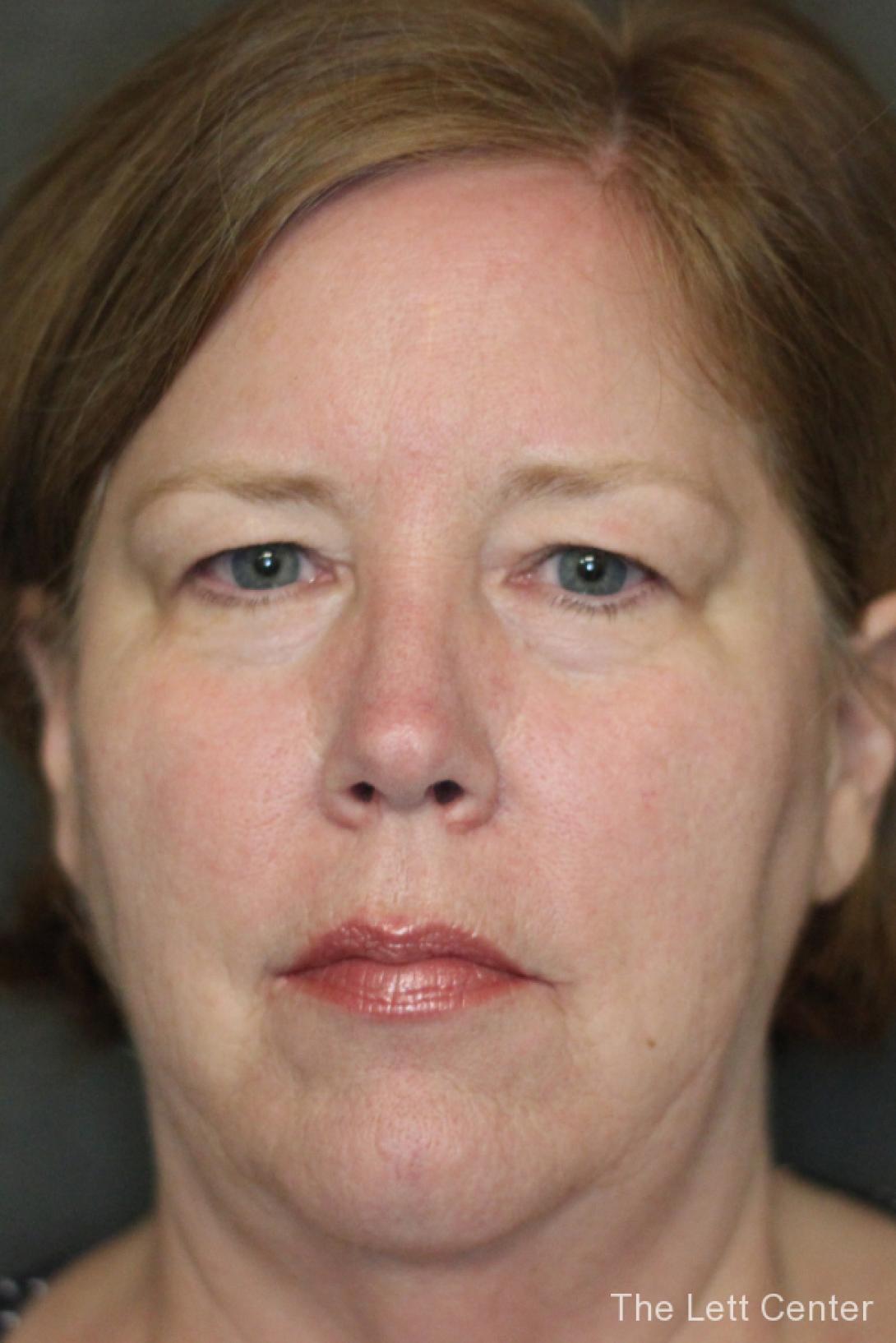 See the results from blepharoplasty or eyelid surgery - Before