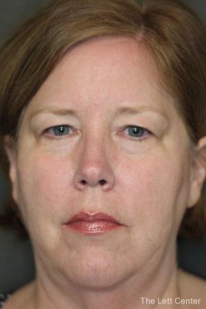 Blepharoplasty: Patient 2 - Before Image 1
