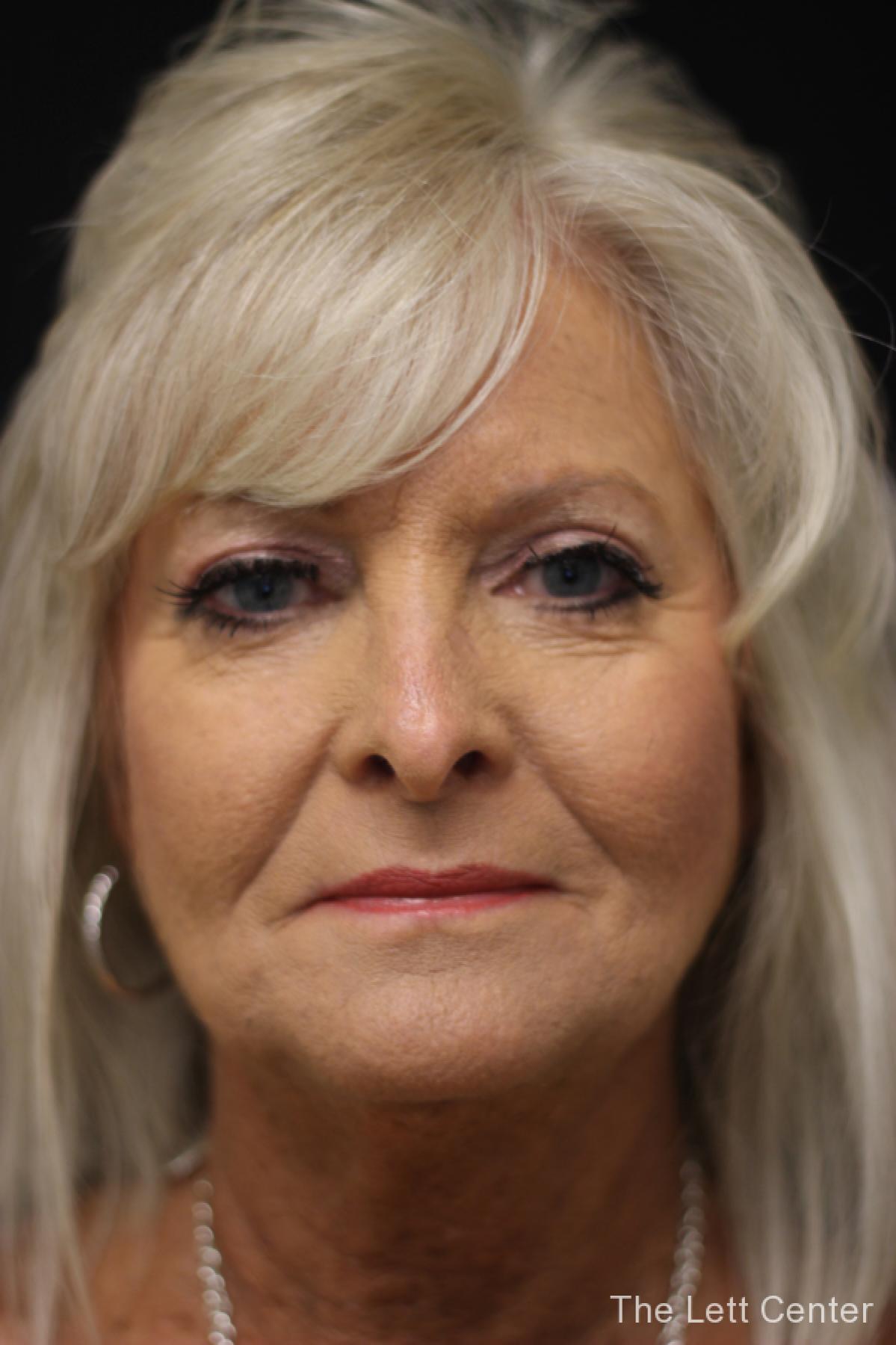 blepharoplasty eyelid surgery - After