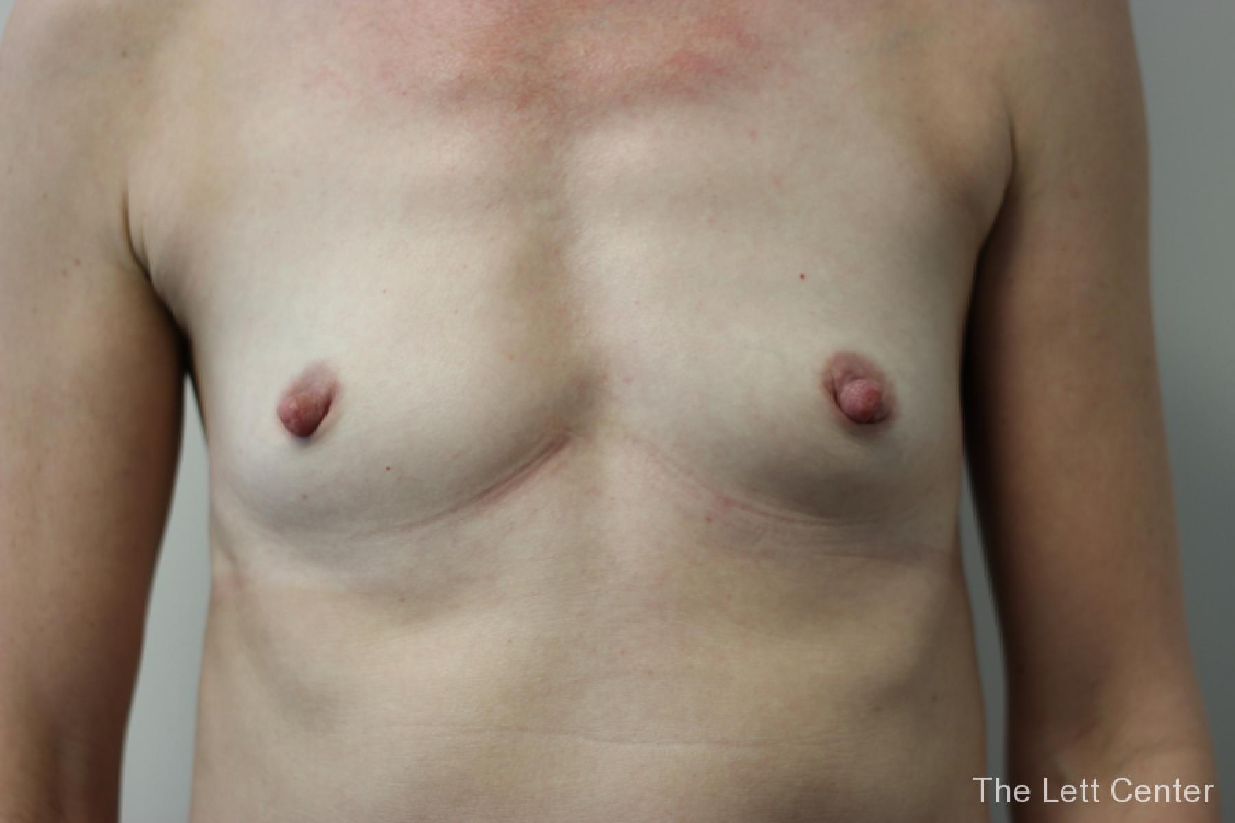 breast enhancement surgery results for patient 4 at the Lett Center - Before 1