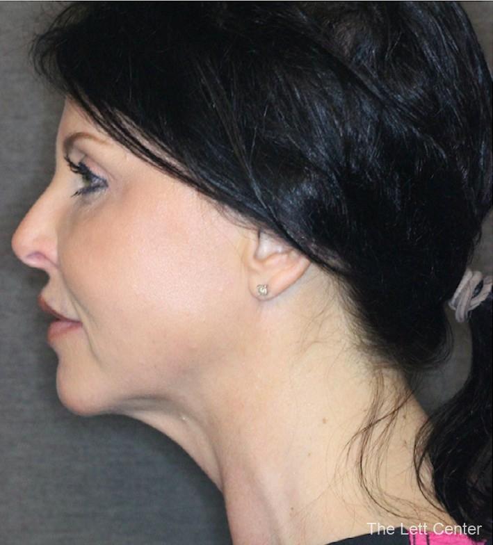Liposuction of the neck - After 1