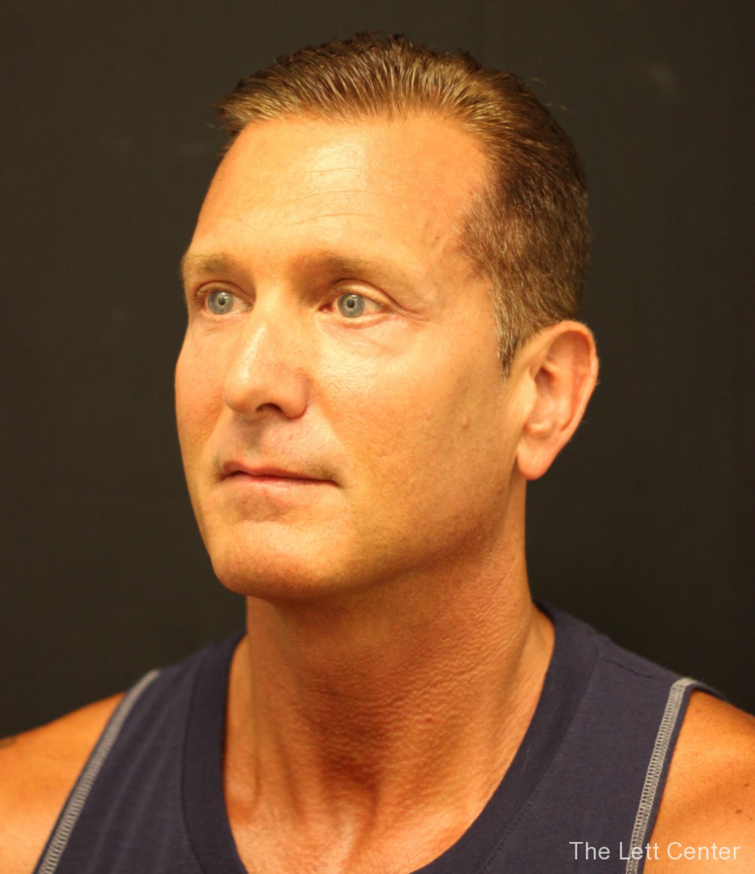 male blepharoplasty - After 5