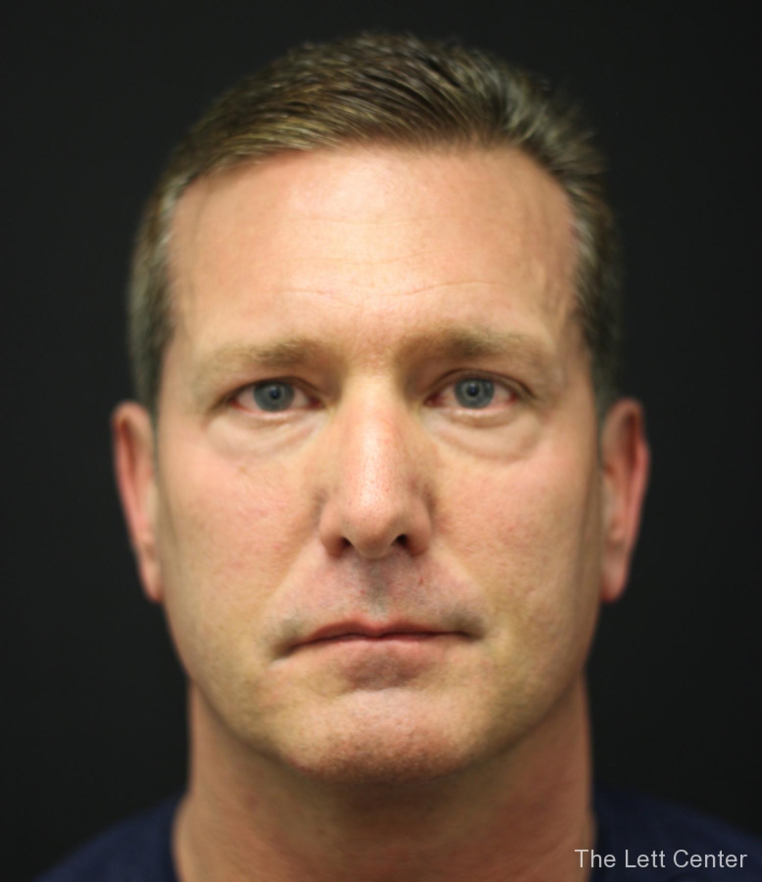 male blepharoplasty - Before