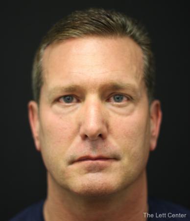 Blepharoplasty: Patient 3 - Before Image 1