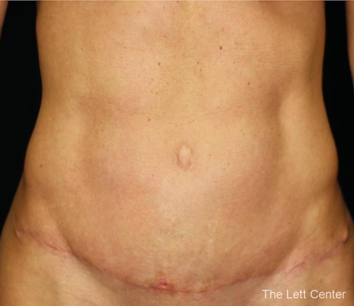 Abdominoplasty Skin Only - After