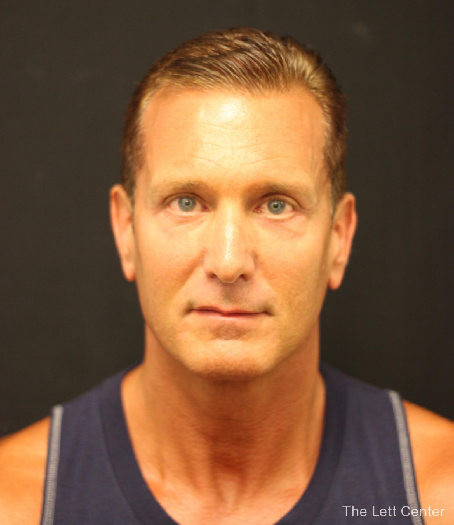 male blepharoplasty - After