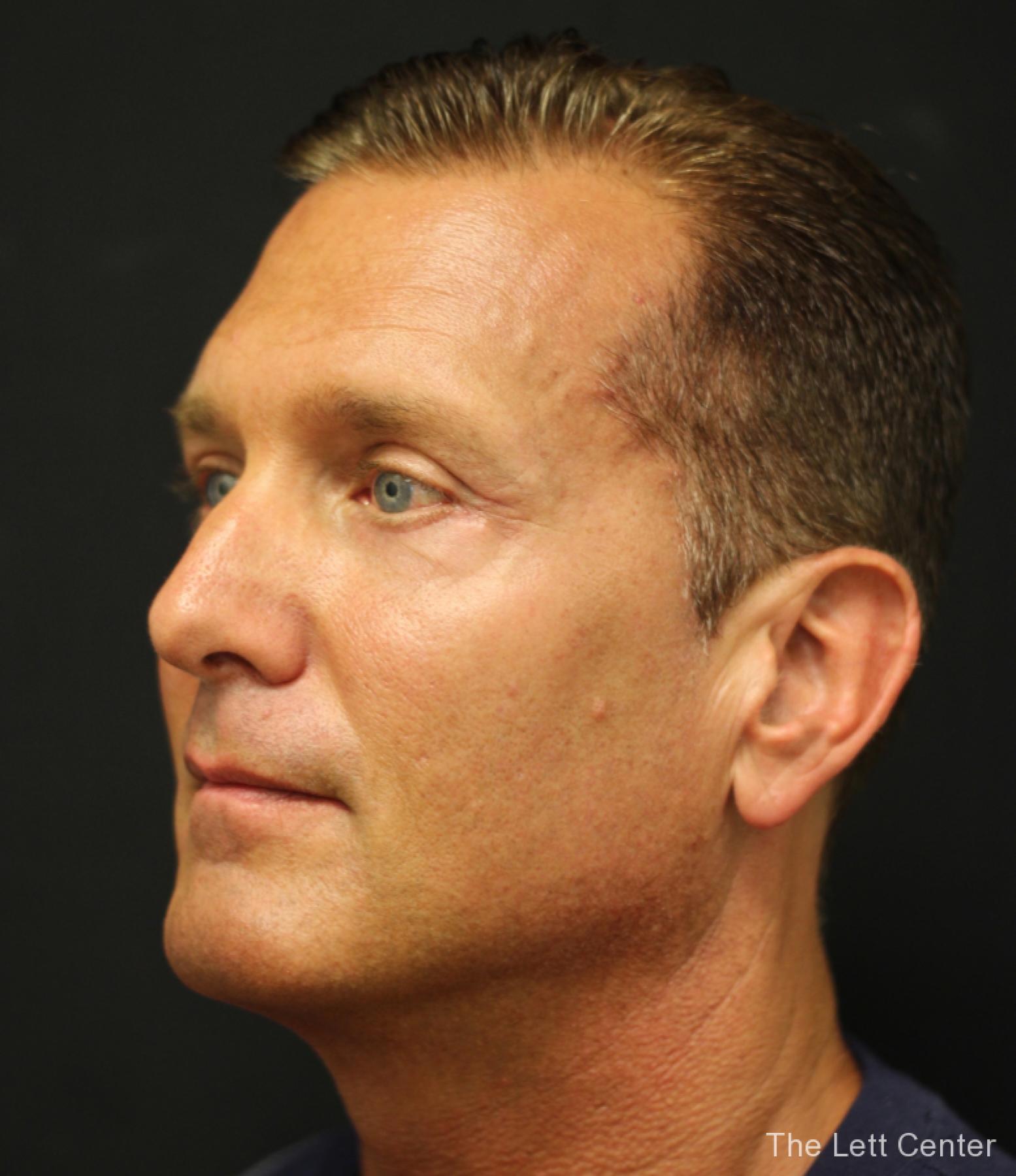 male blepharoplasty - After 4