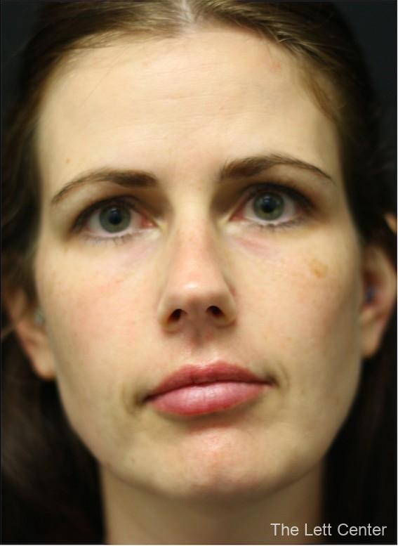 Lip Fillers in Mt. Juliet & Lebanon, TN - Before