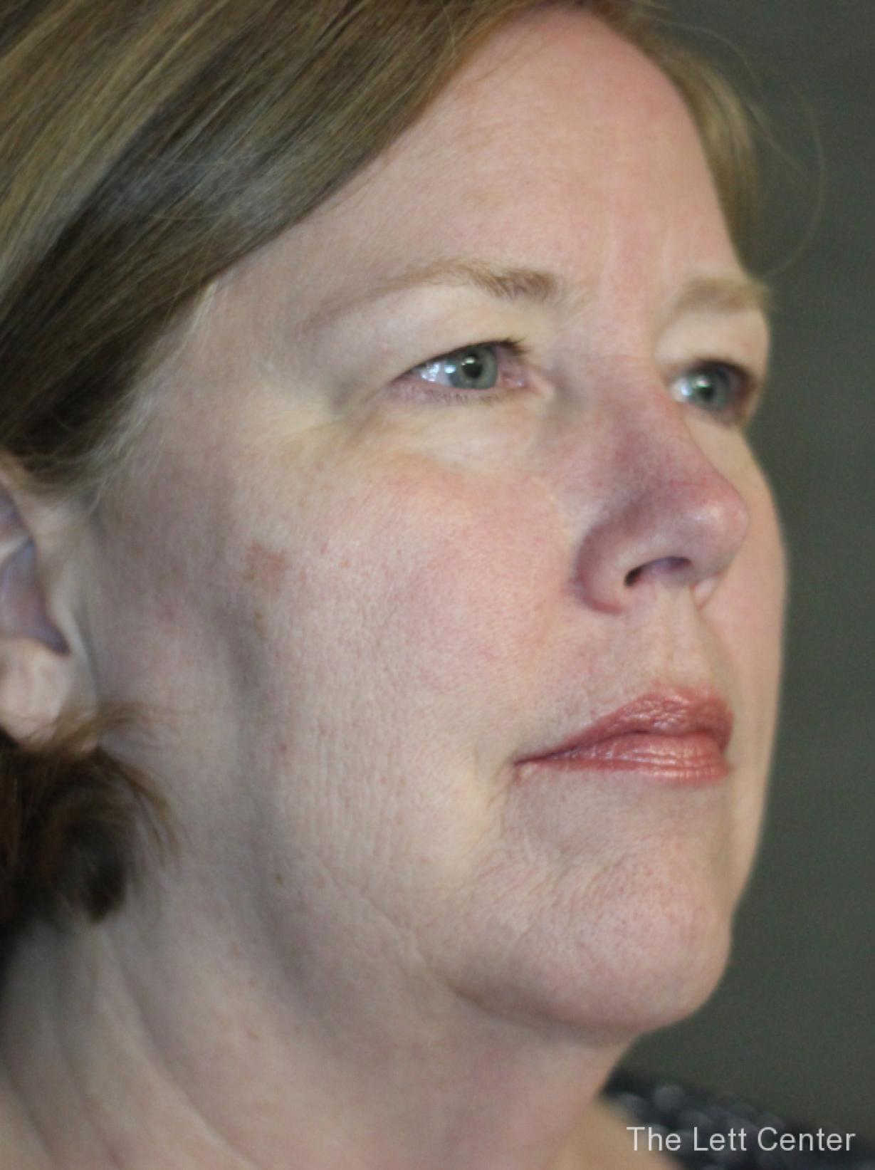 See the results from blepharoplasty or eyelid surgery - Before 3