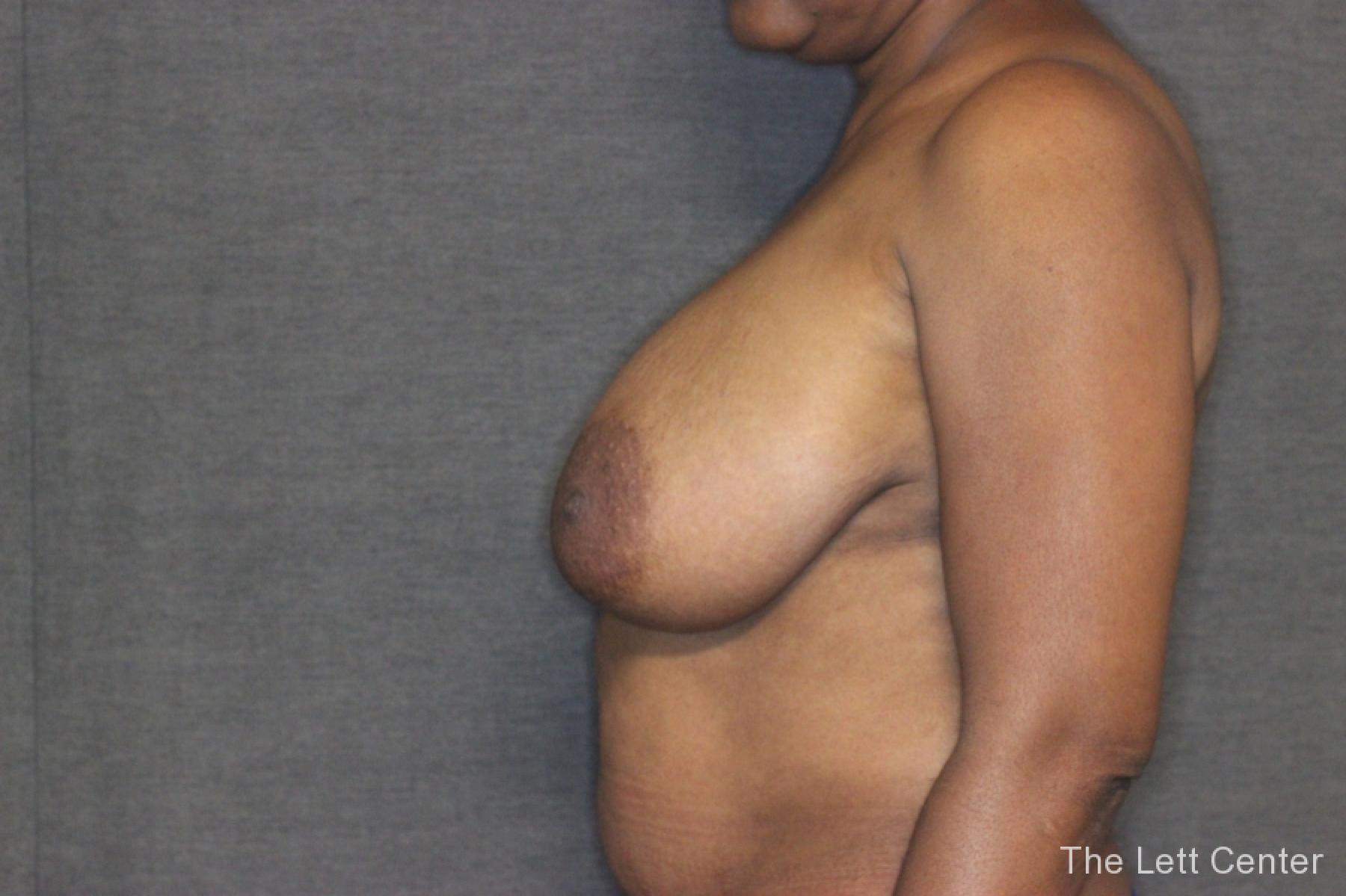 Patient 2 Results from Breast Reduction Surgery at The Lett Center - Before 2