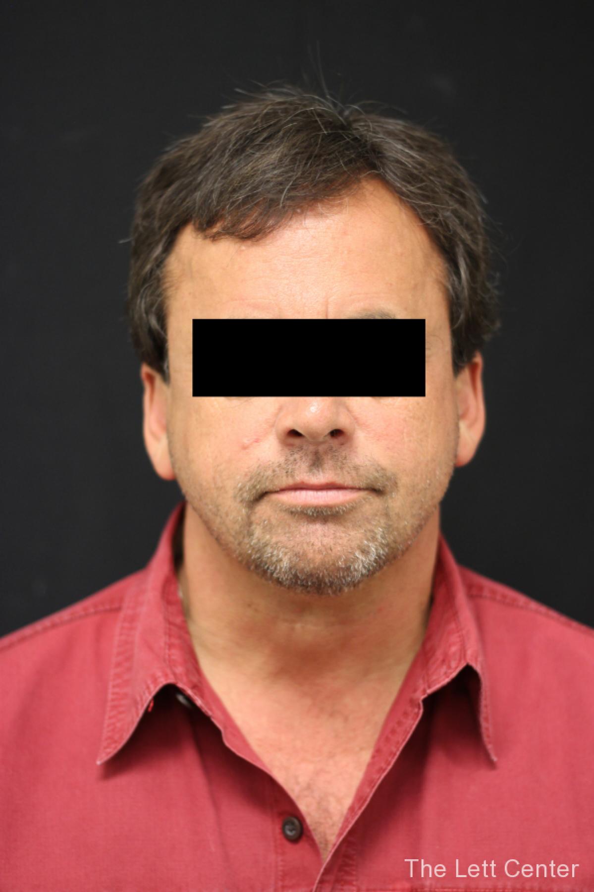 CoolSculpting for Men in Lebanon, TN | Schedule a Consultation Today - After