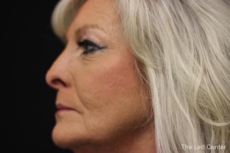 Blepharoplasty: Patient 1 - Before and After Image 3