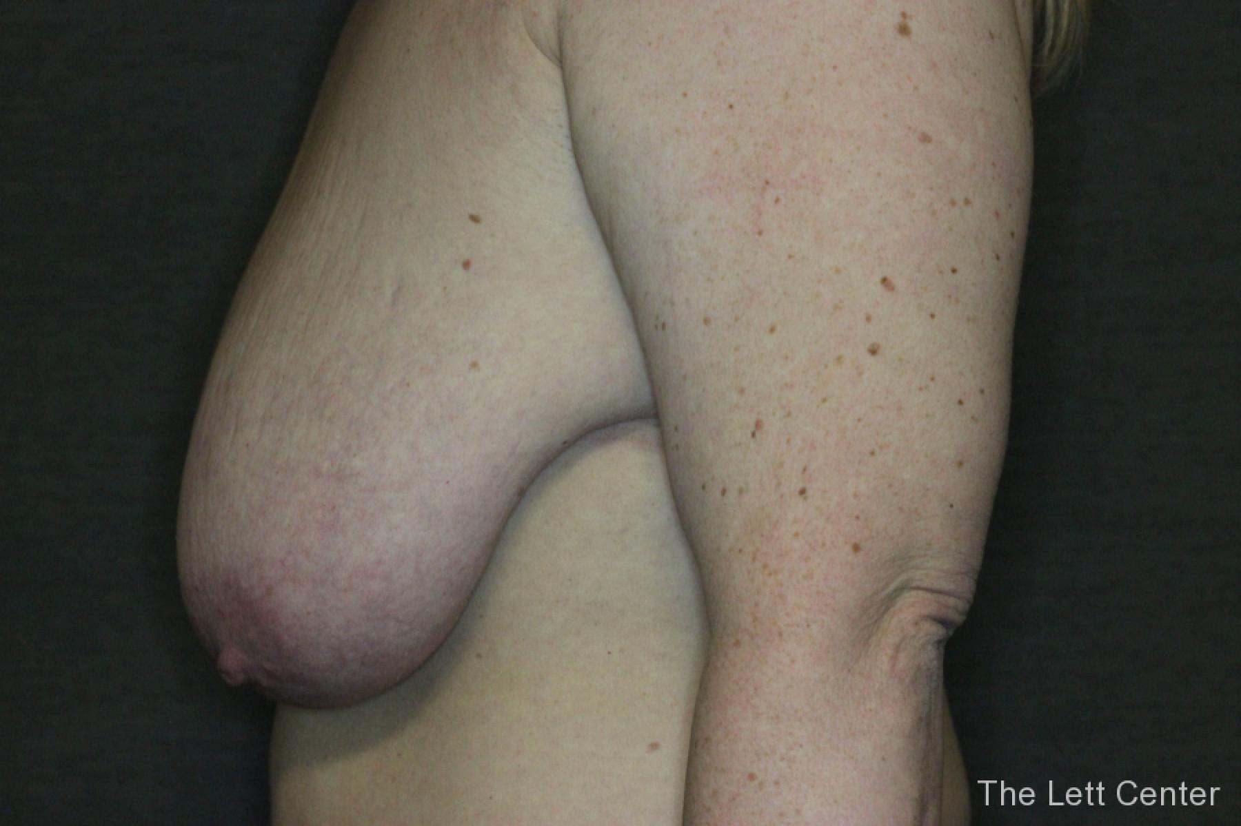 Before and After images from Breast Reduction Surgery - Before 2