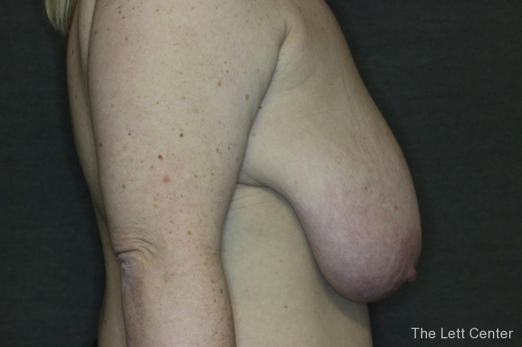 Before and After images from Breast Reduction Surgery - Before and After 3