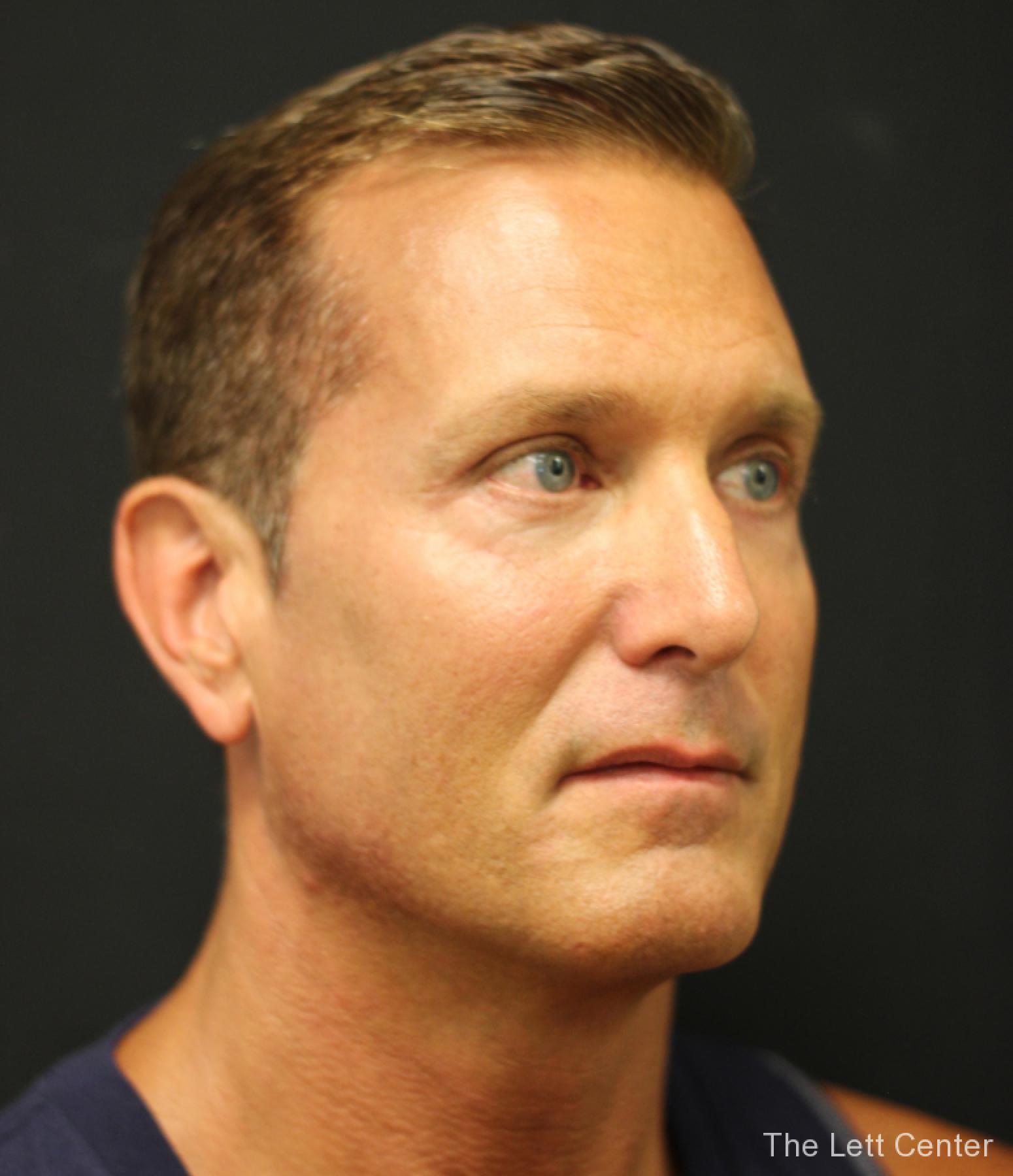 male blepharoplasty - After 2