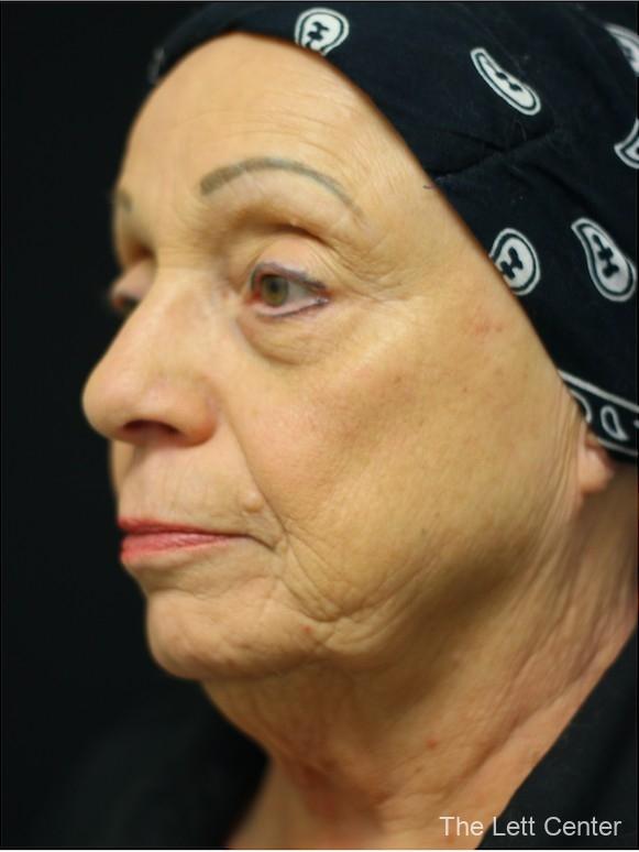 FaceTite with Lower Blepharoplasty - Before and After 2