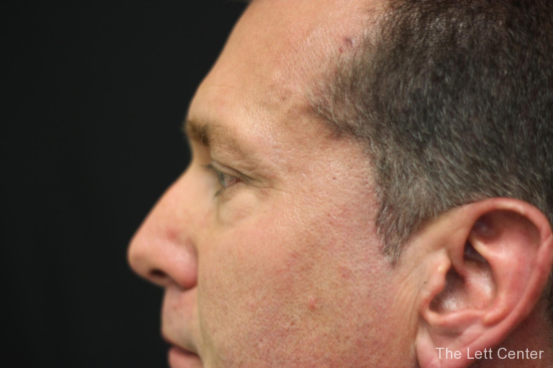 male blepharoplasty - Before 4