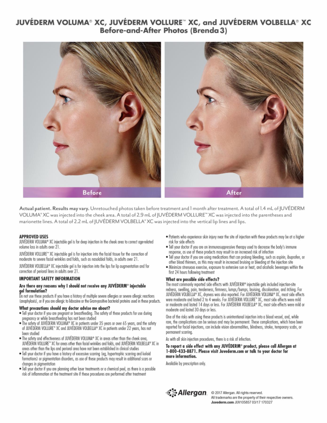 Before and After Gallery for Jevederm XC Dermafillers - Before and After 2