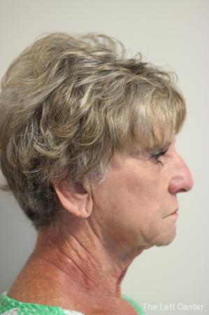 Facelift: Patient 4 - Before Image 3