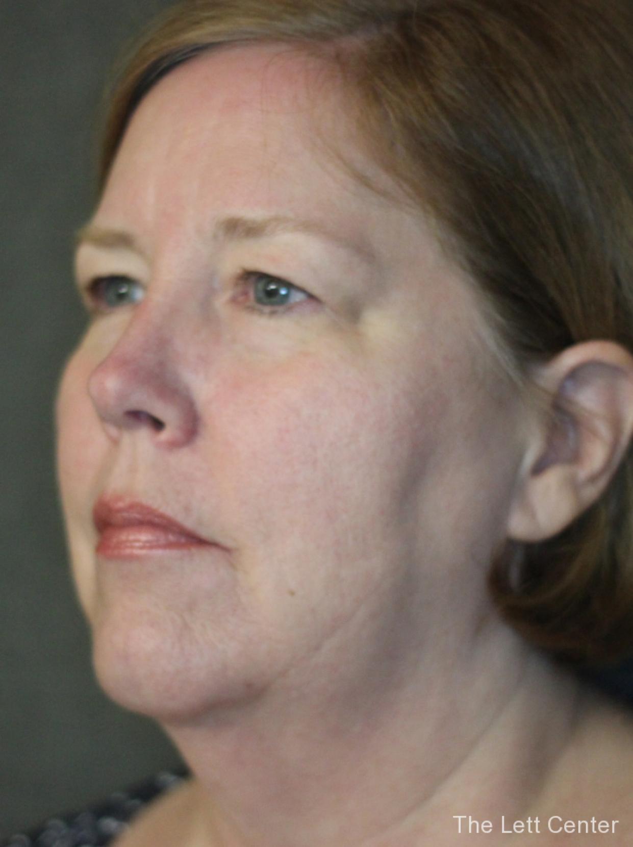 See the results from blepharoplasty or eyelid surgery - Before 2