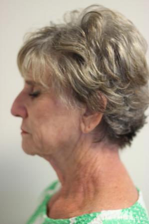 Facelift: Patient 4 - Before Image 2