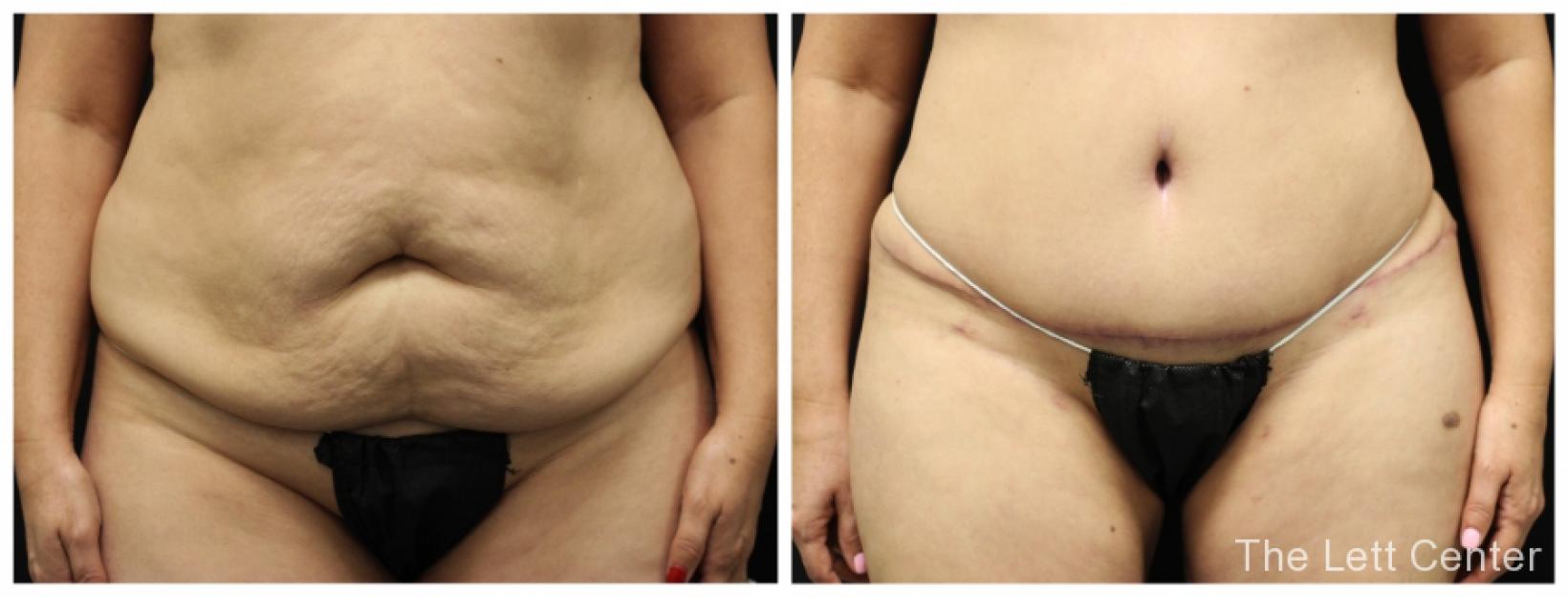 The Lett Center before and after abdominoplasty with lipo in Lebanon, TN - Before and After
