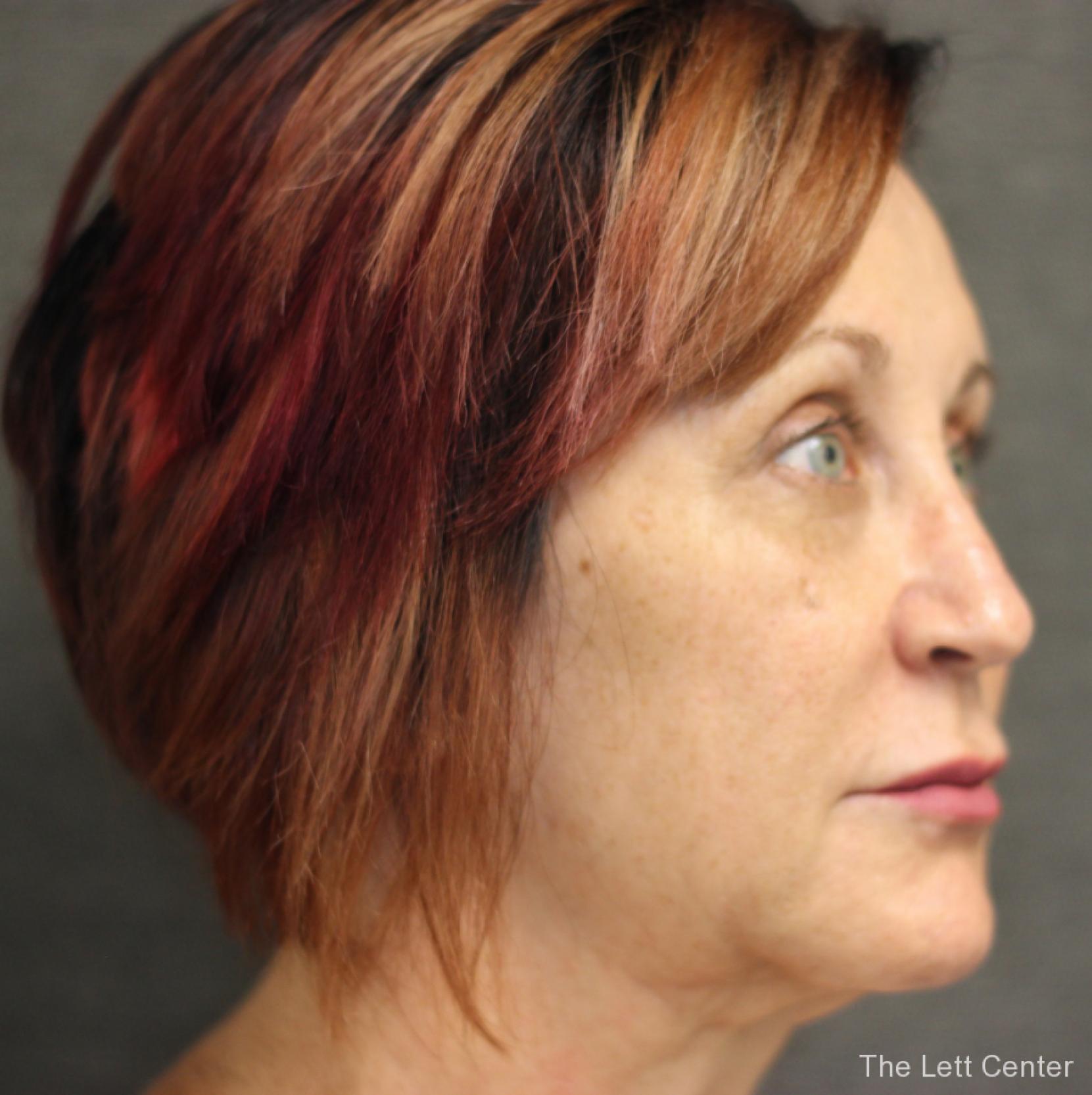 brow lift procedure - After 3