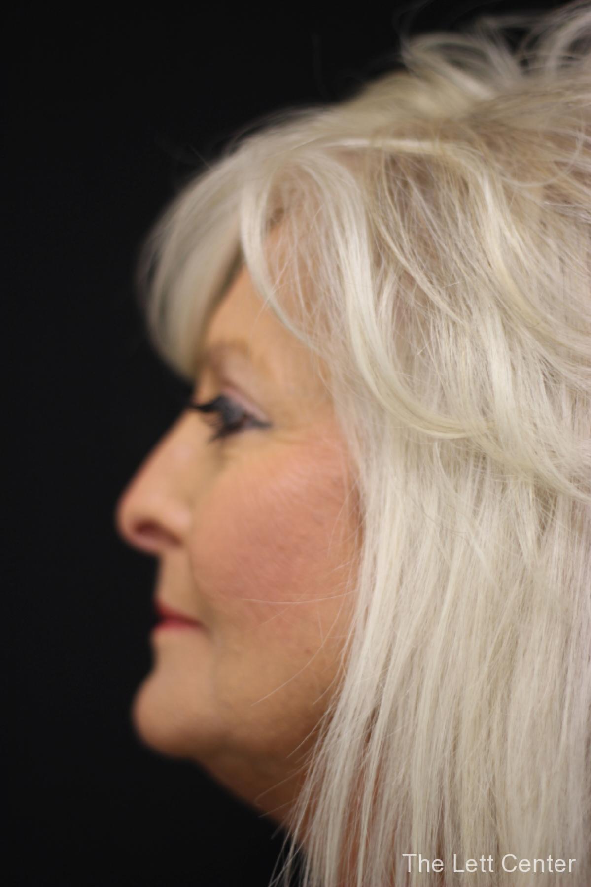 blepharoplasty eyelid surgery - After 3