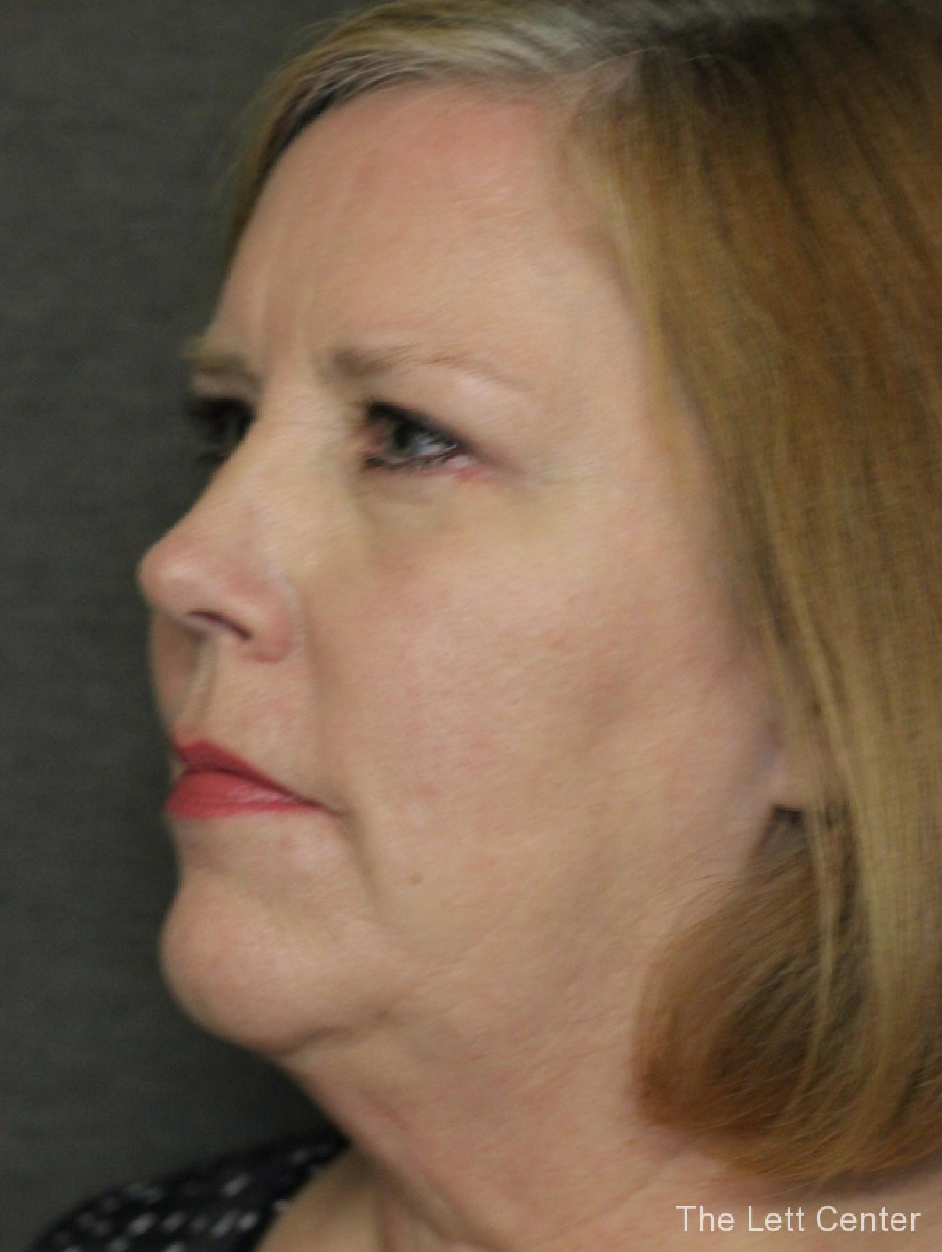 See the results from blepharoplasty or eyelid surgery - After 2