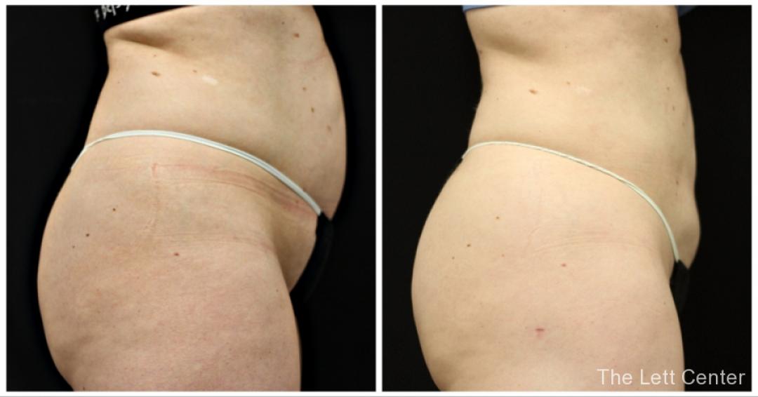 the lett center bodytite + lipo abdomen before and after results at the Lett Center - Before and After