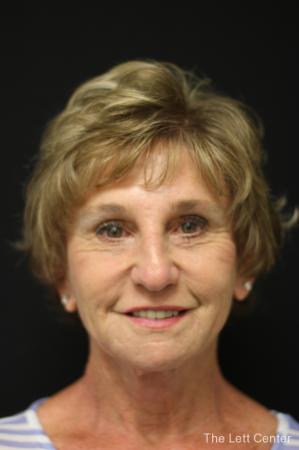 Facelift: Patient 4 - After Image 4