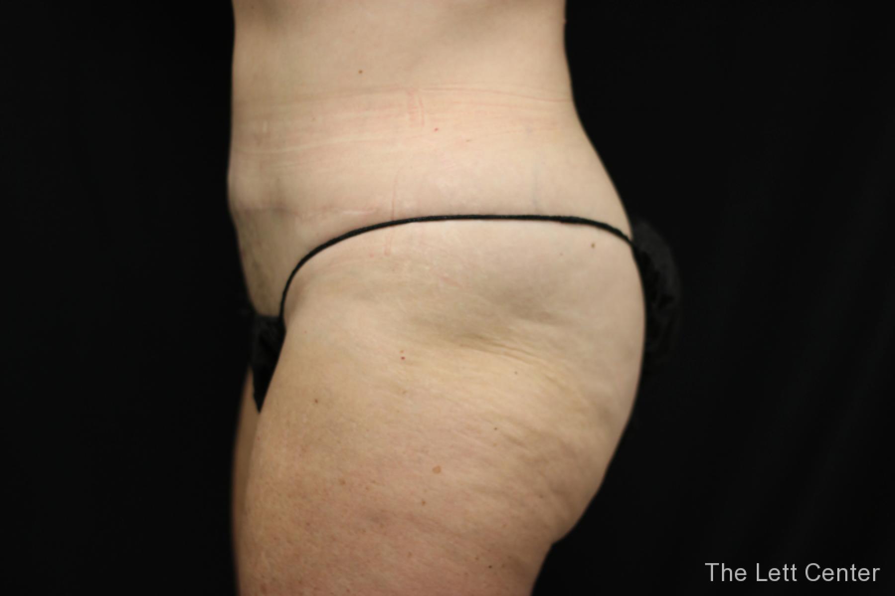 before and after results from BodyTite body sculpting - After 2