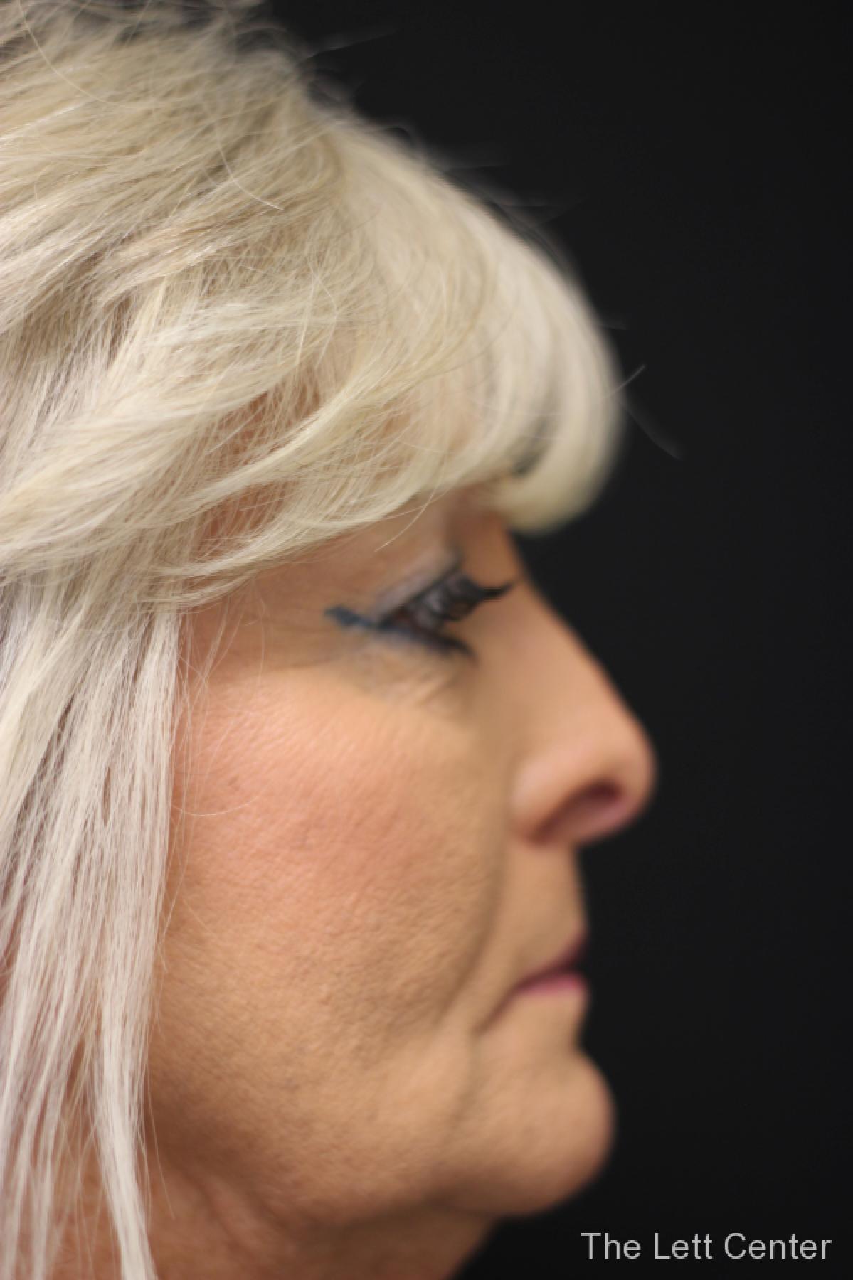 blepharoplasty eyelid surgery - Before 2