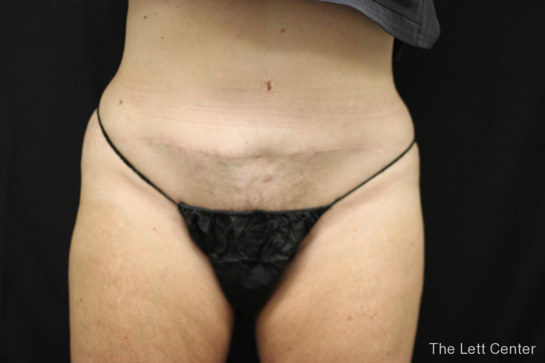 before and after results from BodyTite body sculpting - After