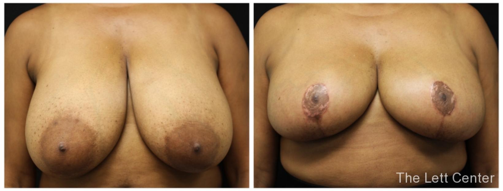 breast reduction with dr lett plastic surgeon in lebanon tn the lett center lebanon - Before and After 1